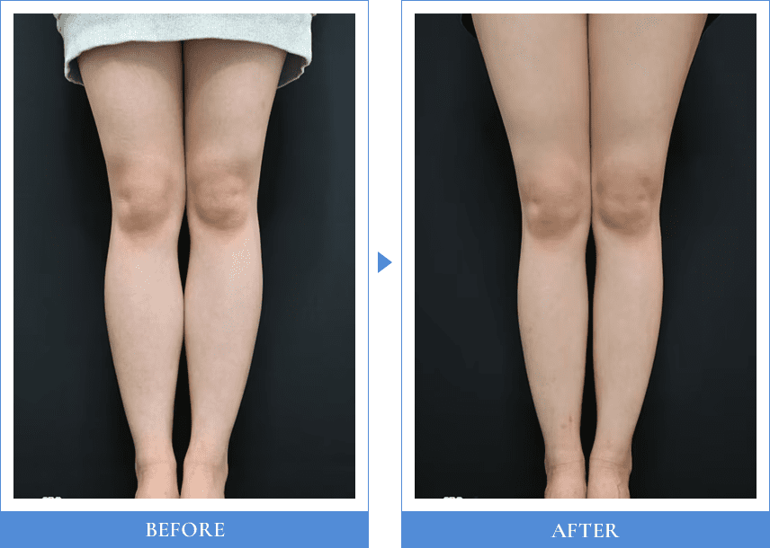 Before After 1