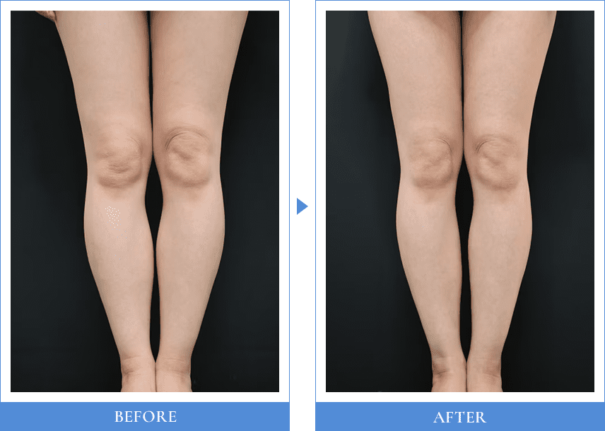Before After 2