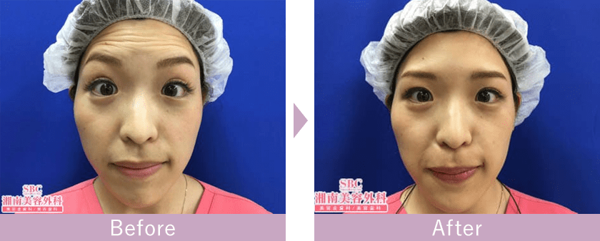 額のボツリヌス注射（ボトックス治療）の症例写真ビフォーアフター