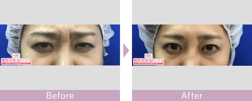 眉間のボツリヌス注射（ボトックス治療）の症例写真ビフォーアフター