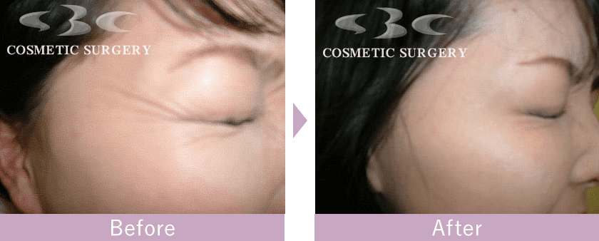 目尻の韓国製ボツリヌストキシンの症例写真ビフォーアフター