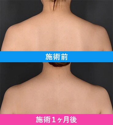 PICKUP症例1
