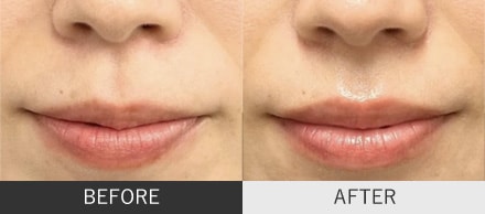 人中短縮ボトックスの症例写真(正面)