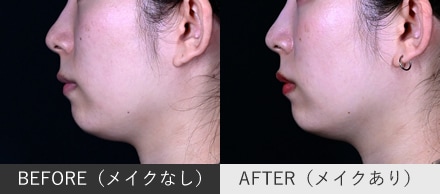 人中短縮ボトックスの症例写真(横顔)