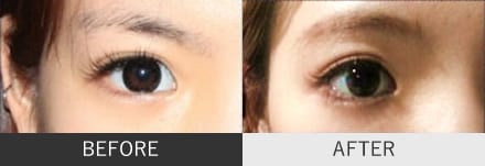 たれ目の症例写真