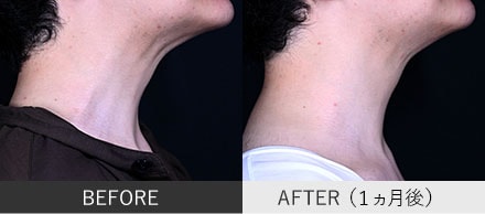 頸部ボトックスの症例写真①