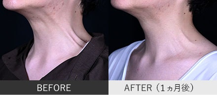頸部ボトックスの症例写真②