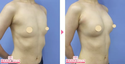 ヒアルロン酸豊胸の施術後直後の症例写真