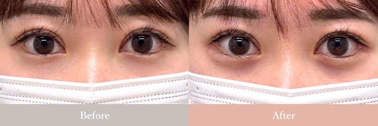 涙袋 症例写真1