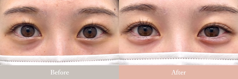 涙袋 症例写真2