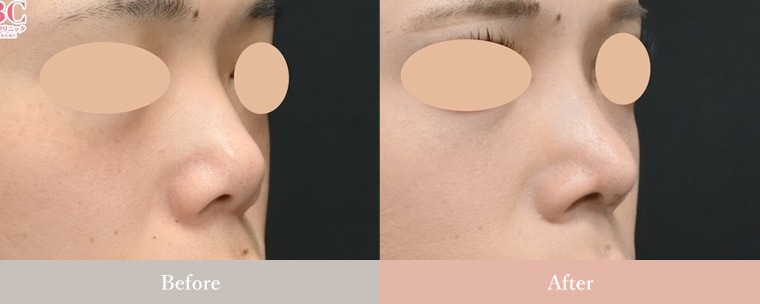 鼻筋・鼻先 症例写真1