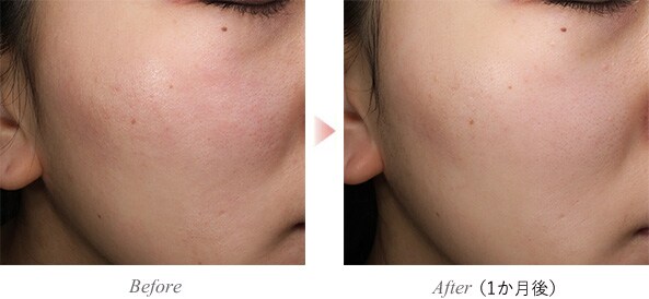 ボライトXC Before After