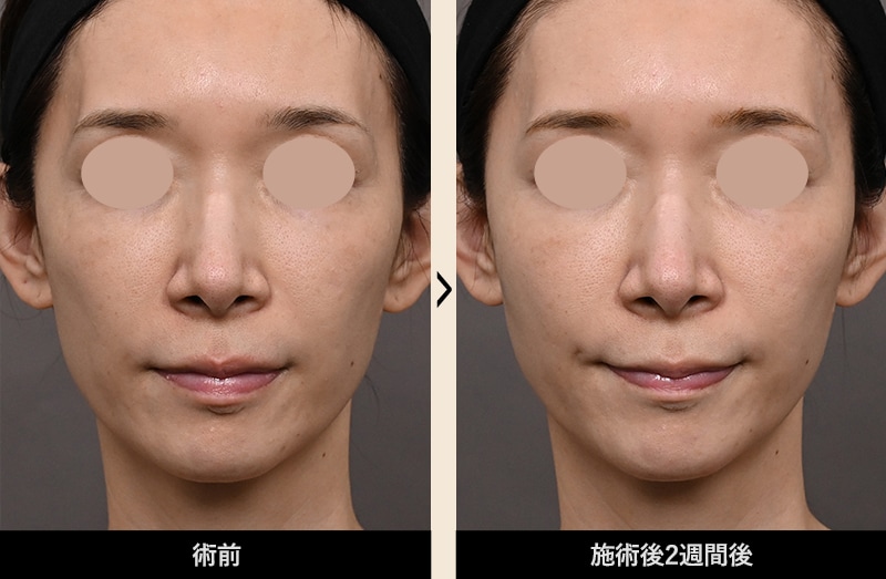 症例写真 Before After