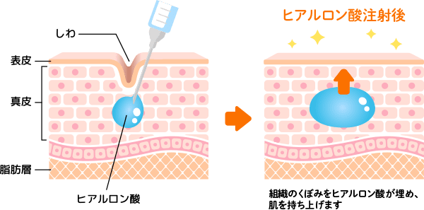 ヒアルロン酸とは