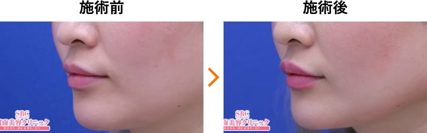 唇ヒアルロン酸 症例写真 １週間後 Before After