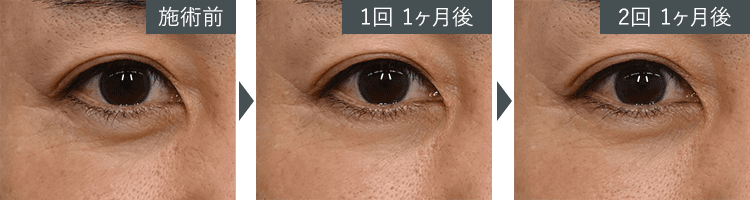 女優注射®~リジュラン+ボトックス~症例写真(目元) Before After