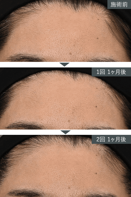 女優注射®~リジュラン+ボトックス~症例写真(額) Before After