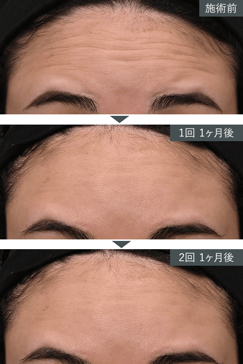 女優注射®~リジュラン+ボトックス~症例写真(額) Before After