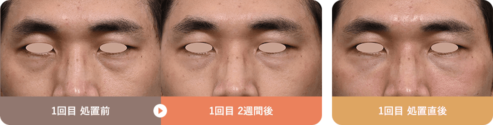 くまぴたスレッド 症例写真01