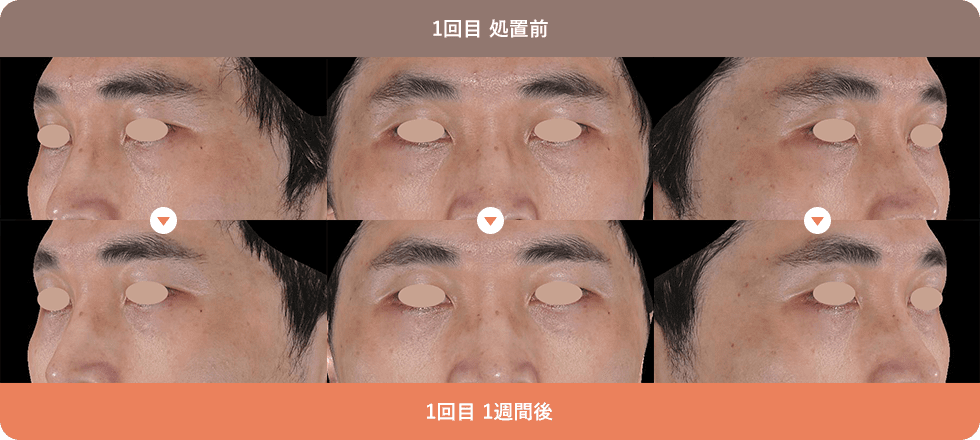 くまぴたスレッド 症例写真01