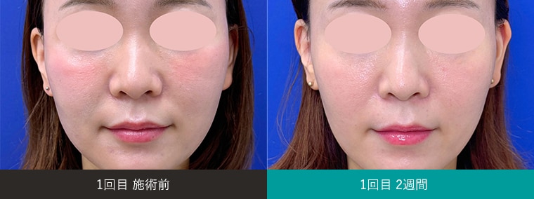 ぽにょぴたスレッド+Extender Master+Multi-Fill 症例写真2