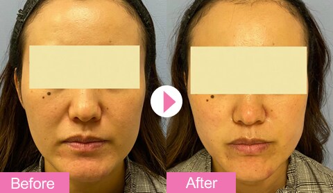 うるおいコラーゲンリフト 若返り エイジングケアなら湘南美容クリニック 公式