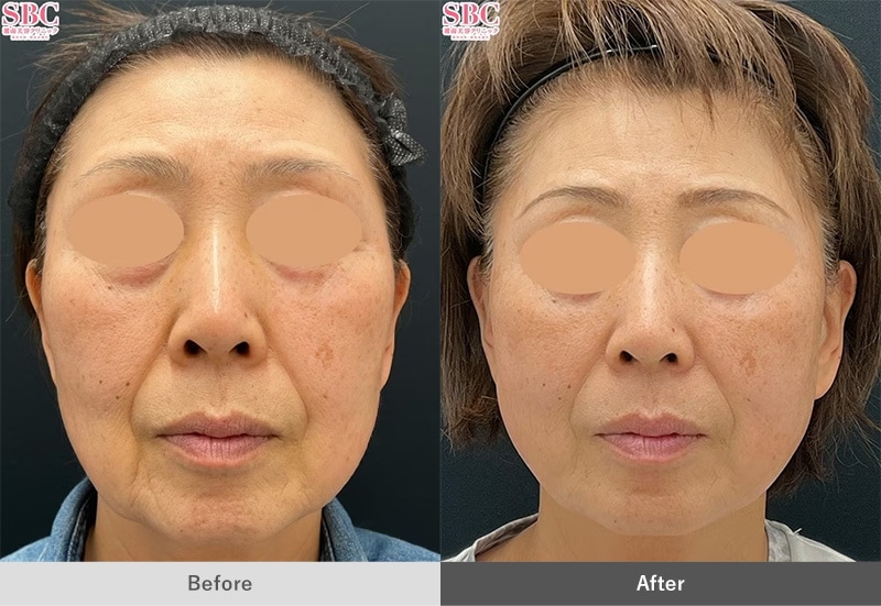 うるおいコラーゲンリフトの症例写真02