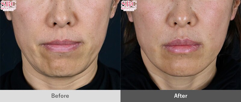 うるおいコラーゲンリフト(ショッピングスレッドリフト)｜若返り