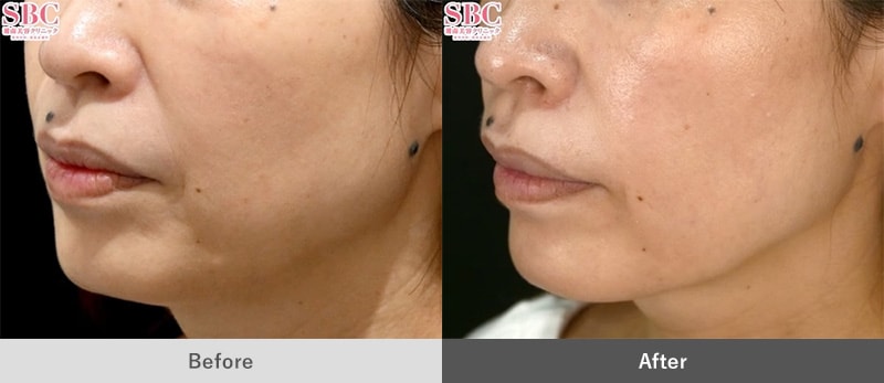 うるおいコラーゲンリフト(ショッピングスレッドリフト)｜若返り