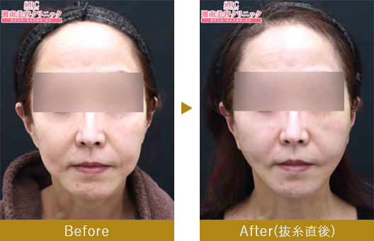 切開リフト（ナチュラルクイックリフト）　before after