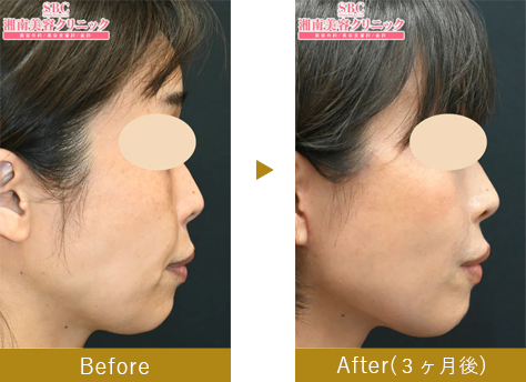 切開リフト（スマスフェイスリフト）　before after