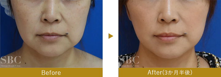 切開リフト（フェイスネックリフト）　before after