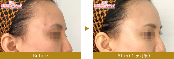 切開リフト（コメカミリフト）　before after