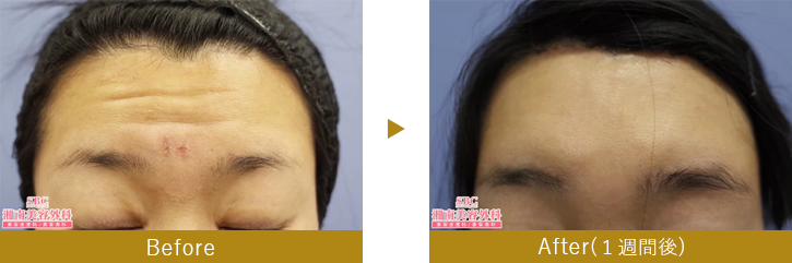 切開リフト（切開式前額リフト）　before after