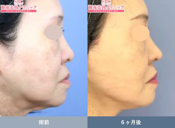 ネックリフトの症例写真03