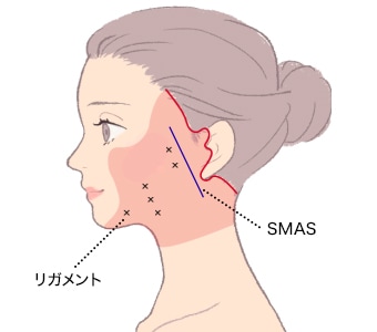 Deep Plane Facelift or High SMAS