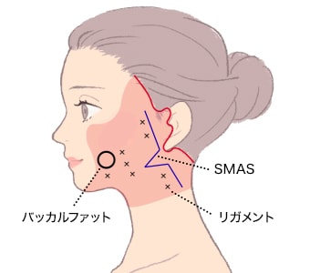 Extended Deep Plane Facelift or Extended high SMAS
