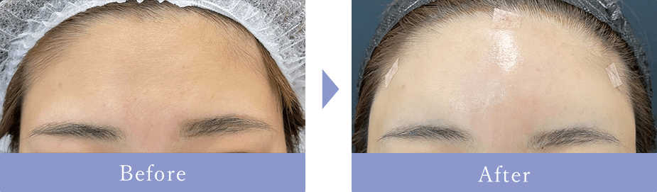 Before After