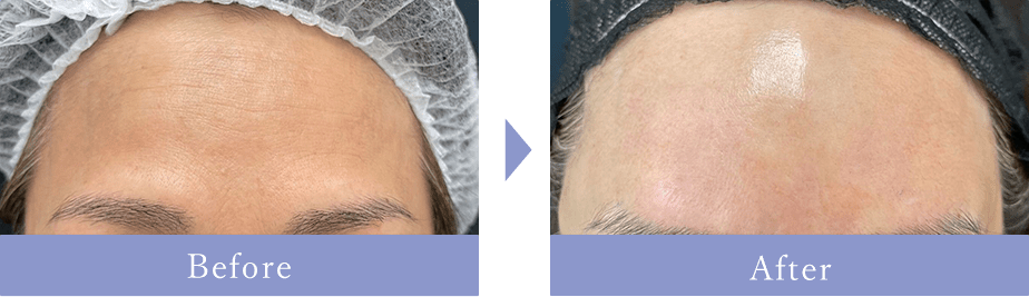 Before After