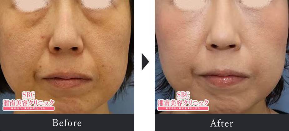 Before After