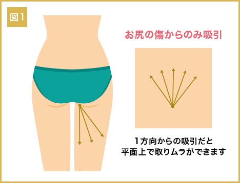 図1：お尻の傷からのみ吸引
