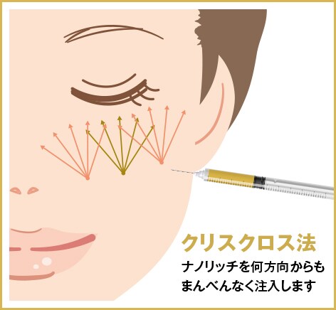 クリスクロス法