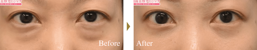 ナノリッチ（脂肪注入）と目の下凹み・膨らみの症例写真ビフォーアフター