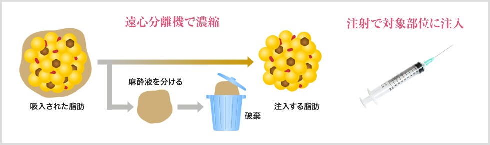 SBCリッチフェイスとは