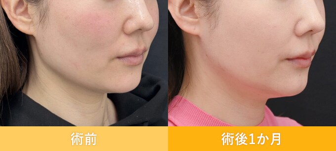 ナチュラル脂肪注射(お顔の脂肪注入)のピックアップ症例写真07