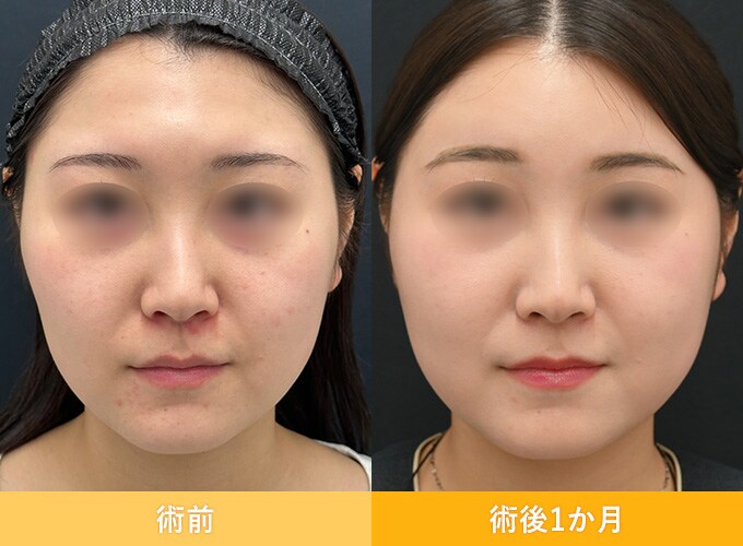 ナチュラル脂肪注射(お顔の脂肪注入)のピックアップ症例写真08