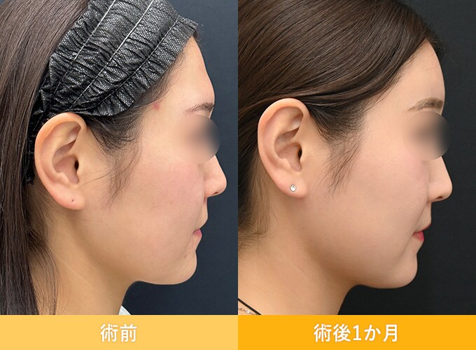 ナチュラル脂肪注射(お顔の脂肪注入)のピックアップ症例写真09
