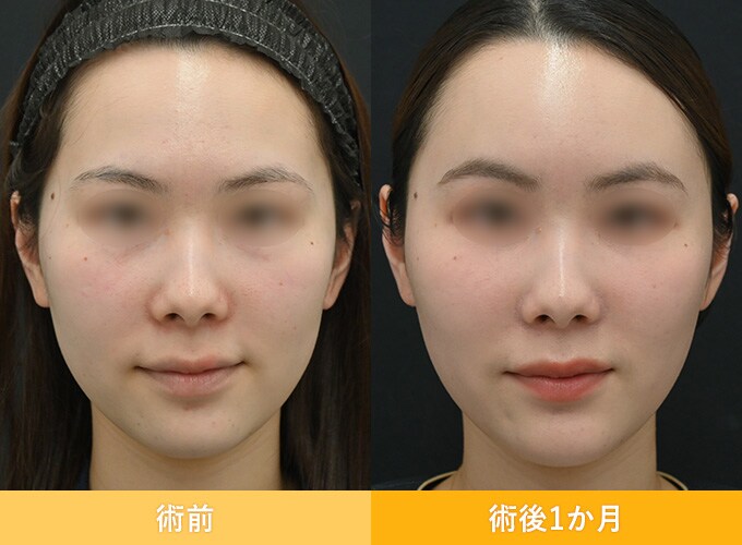 ナチュラル脂肪注射(お顔の脂肪注入)のピックアップ症例写真10