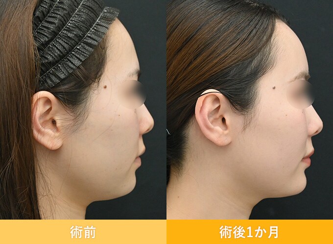 ナチュラル脂肪注射(お顔の脂肪注入)のピックアップ症例写真11