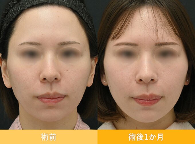ナチュラル脂肪注射(お顔の脂肪注入)のピックアップ症例写真12